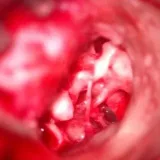 Otología y microcirugía- Microcirugía de oído