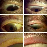 Ophthalmology MCQ - Ophthalmology