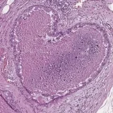 Uropathack-uropatología